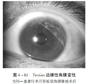 terrien边缘性角膜变性