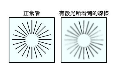 近视手术可以"治疗"散光吗