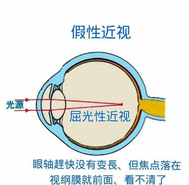 首先,散瞳一般是没有太大的危害的,按照医嘱正确散瞳对孩子来说